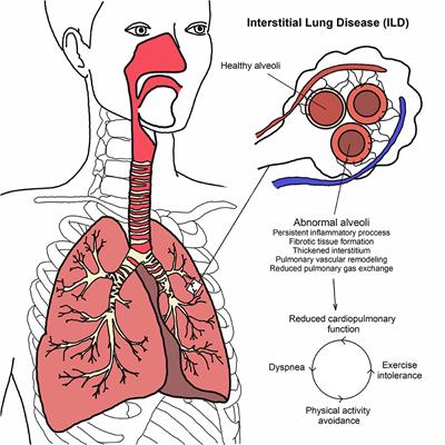 Exercise-Based Pulmonary Rehabilitation for Interstitial Lung Diseases: A Review of Components, Prescription, Efficacy, and Safety